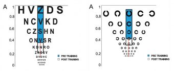 L’apprendimento percettivo migliora la sensibilità al contrasto e l’acuità visiva nelle basse miopie