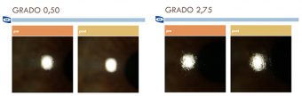 Valutazione in vivo della bagnabilità delle lenti a contatto, mediante una grading scale fotografica